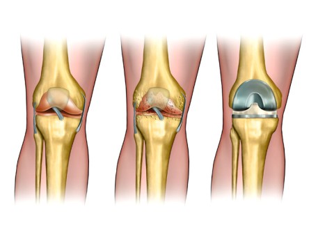 Computer-Assisted Robotic Total Knee Replacement by OrangeCountySurgeons